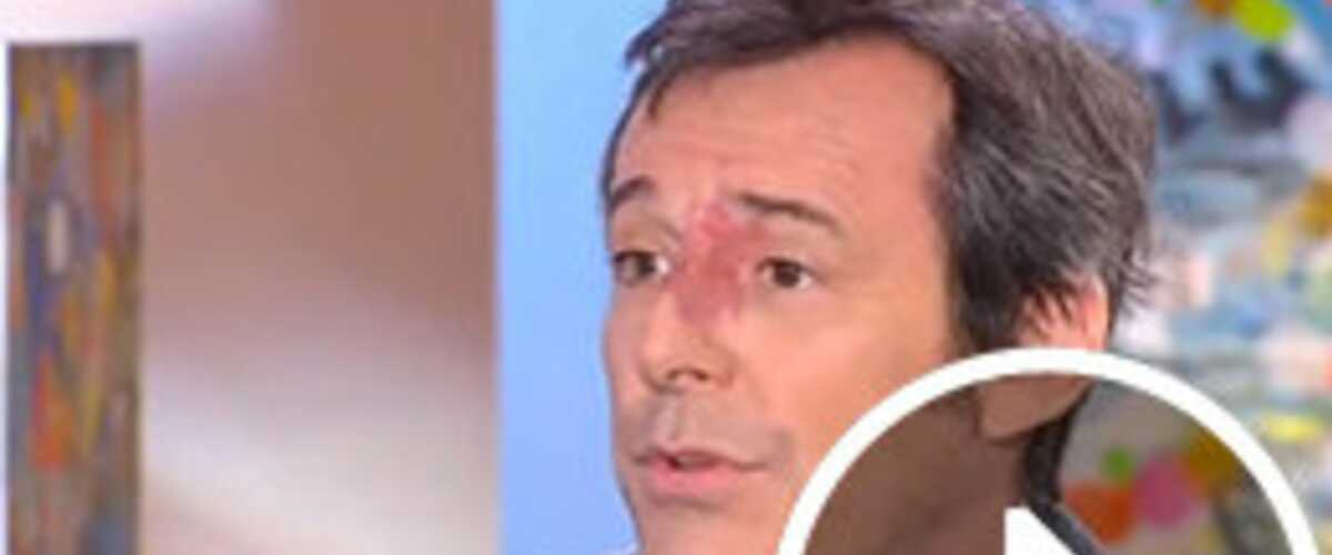 Jean-Luc Reichmann : Pourquoi a-t-il gardé sa tache de naissance sur le nez ? (VIDEO)