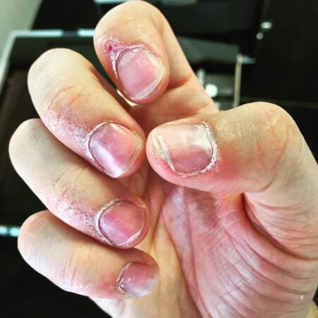 Vous voulez avoir peur ? Voici les ongles de Vianney après une tournée. 
