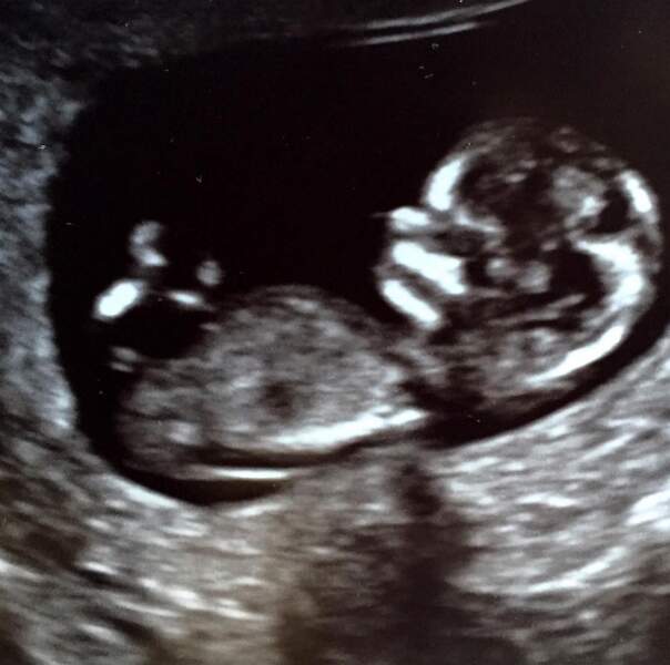 Bonne nouvelle : Katherine Heigl, déjà maman de 2 petites filles adoptées, est enceinte. 