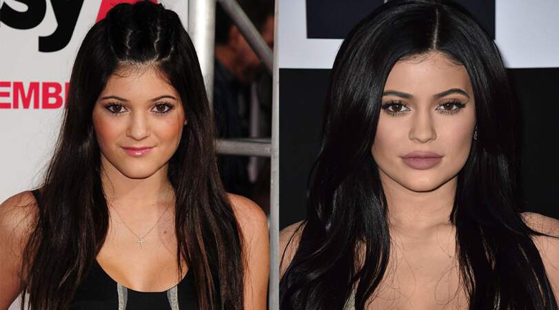 Et on termine avec Kylie Jenner, 21 ans, qui a nié avant d'avouer une opération aux lèvres. Sans blague. 